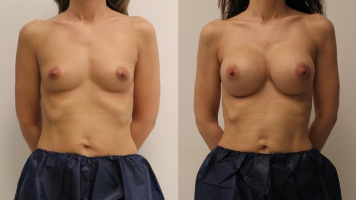 Before & After Breast Augmentation Case 110 Front View in Barrington, Illinois