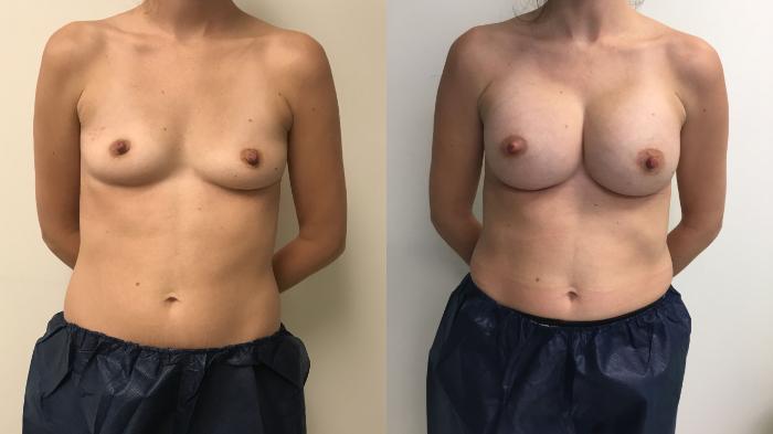 Before & After Breast Augmentation Case 216 Front View in Barrington, Illinois