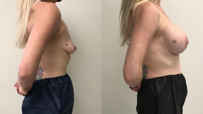 Before & After Breast Augmentation Case 234 Right Side View in Barrington, Illinois