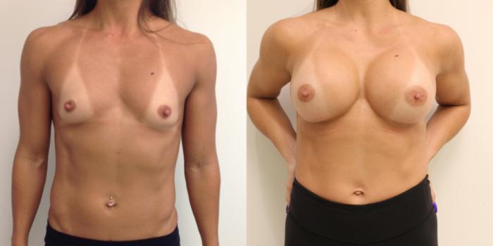 Before & After Breast Augmentation Case 39 View #1 View in Barrington, Illinois