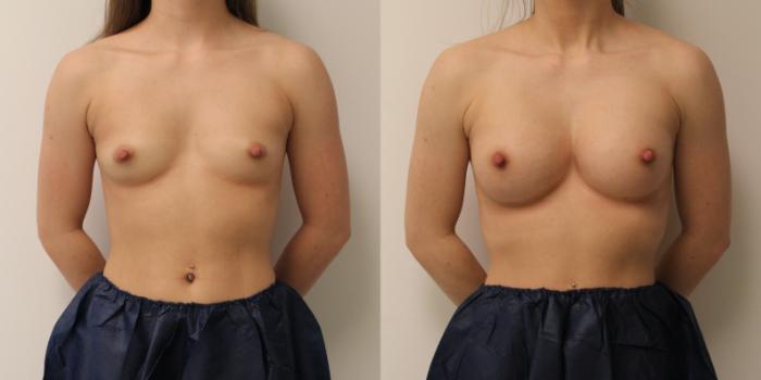 Before & After Breast Augmentation Case 53 View #1 View in Barrington, Illinois