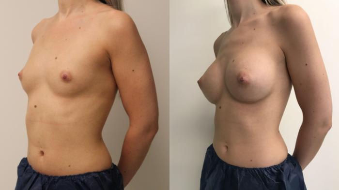 Before & After Breast Augmentation Case 99 Left Oblique View in Barrington, Illinois