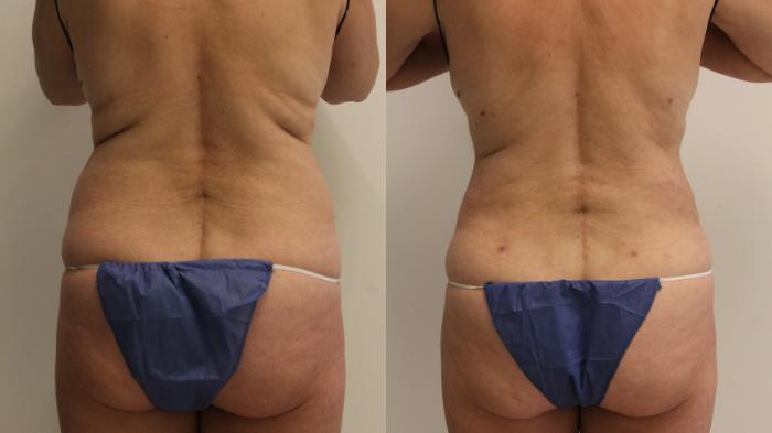 Before & After Liposuction Case 102 Back View in Barrington, Illinois