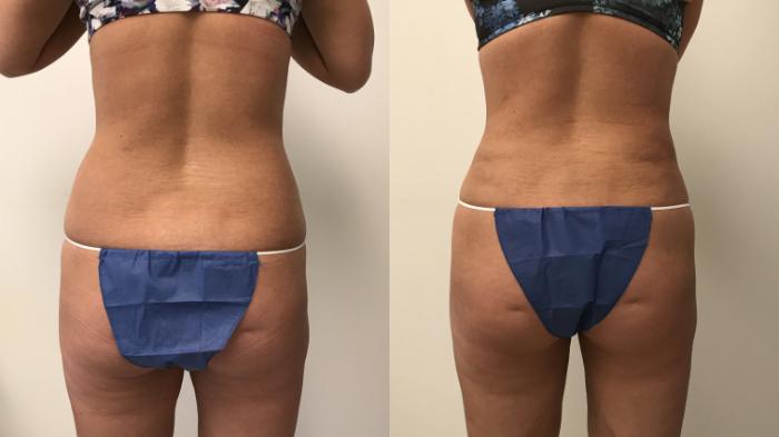 Before & After Liposuction Case 143 Back View in Barrington, Illinois