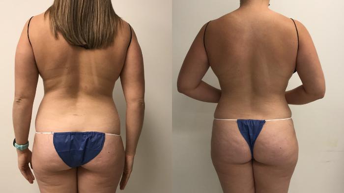 Before & After Liposuction Case 261 Back View in Barrington, Illinois