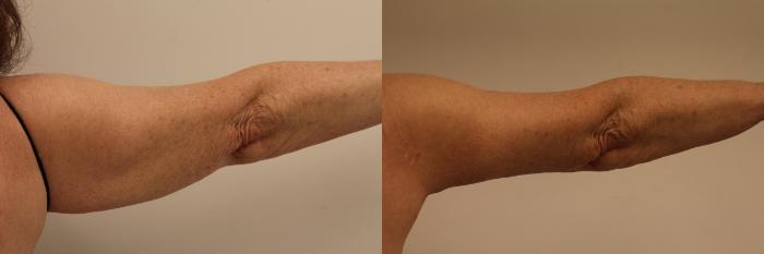Before & After Arm Lift (Brachioplasty) Case 112 Back View in Barrington, Illinois