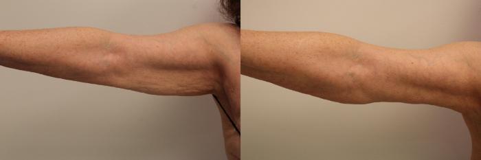 Before & After Arm Lift (Brachioplasty) Case 112 Front View in Barrington, Illinois