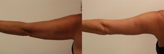 Before & After Arm Lift (Brachioplasty) Case 135 Back View in Barrington, Illinois