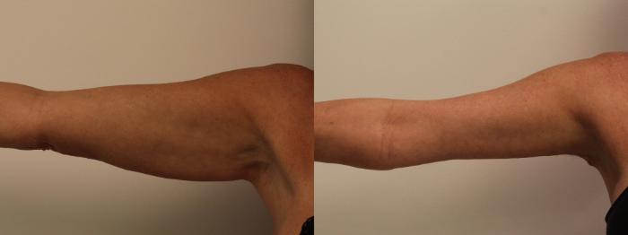Before & After Arm Lift (Brachioplasty) Case 135 Front View in Barrington, Illinois