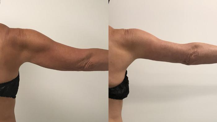 Before & After Arm Lift (Brachioplasty) Case 208 Back View in Barrington, Illinois