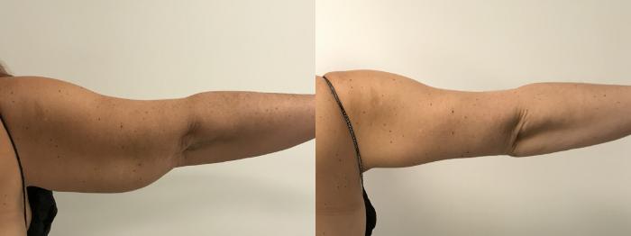 Before & After Arm Lift (Brachioplasty) Case 283 Back View in Barrington, Illinois