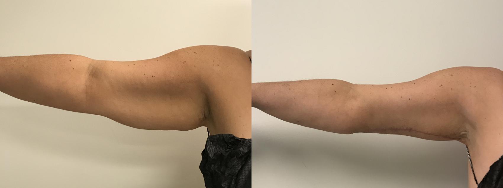 Before & After Arm Lift (Brachioplasty) Case 283 Front View in Barrington, Illinois