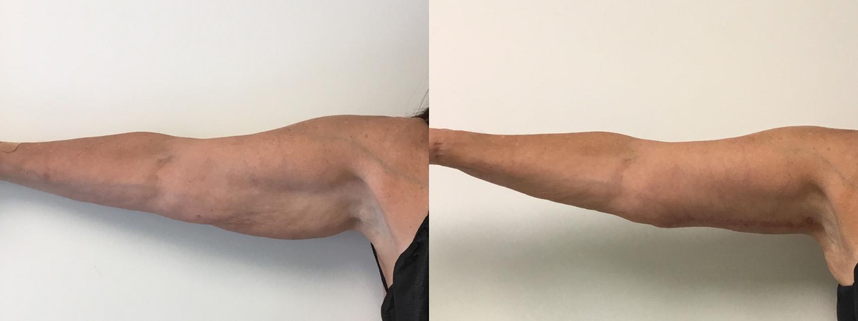 Before & After Arm Lift (Brachioplasty) Case 287 Front View in Barrington, Illinois