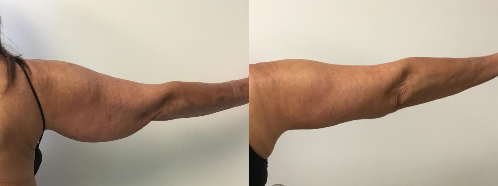 Before & After Arm Lift (Brachioplasty) Case 288 Back View in Barrington, Illinois