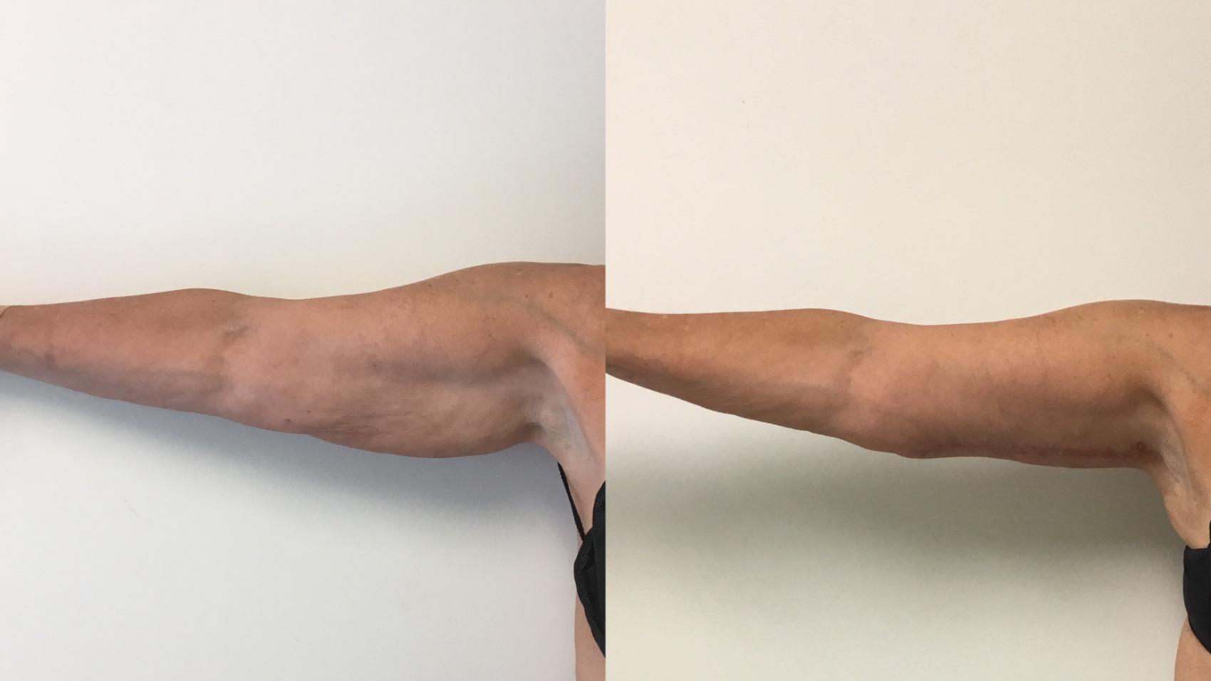 Before & After Arm Lift (Brachioplasty) Case 313 Front View in Barrington, Illinois