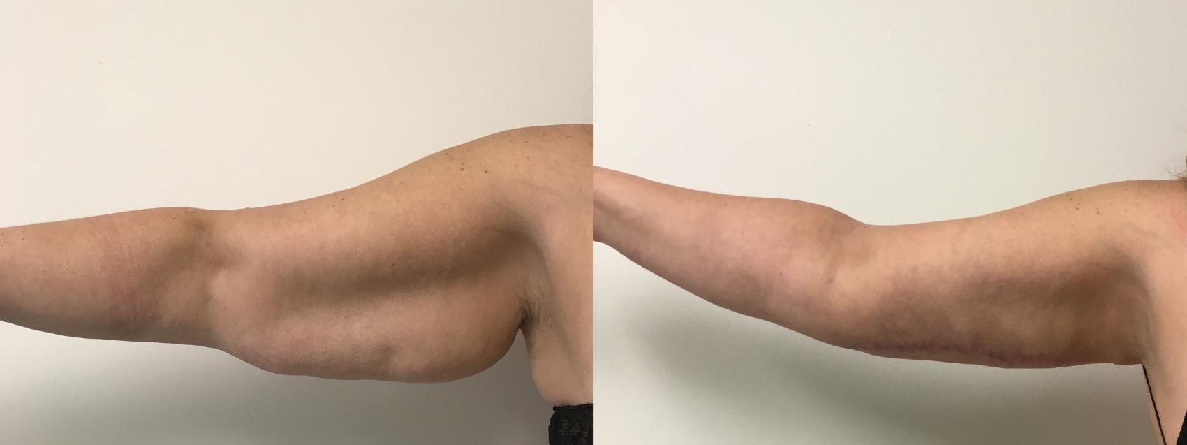 Before & After Arm Lift (Brachioplasty) Case 327 Front View in Barrington, Illinois