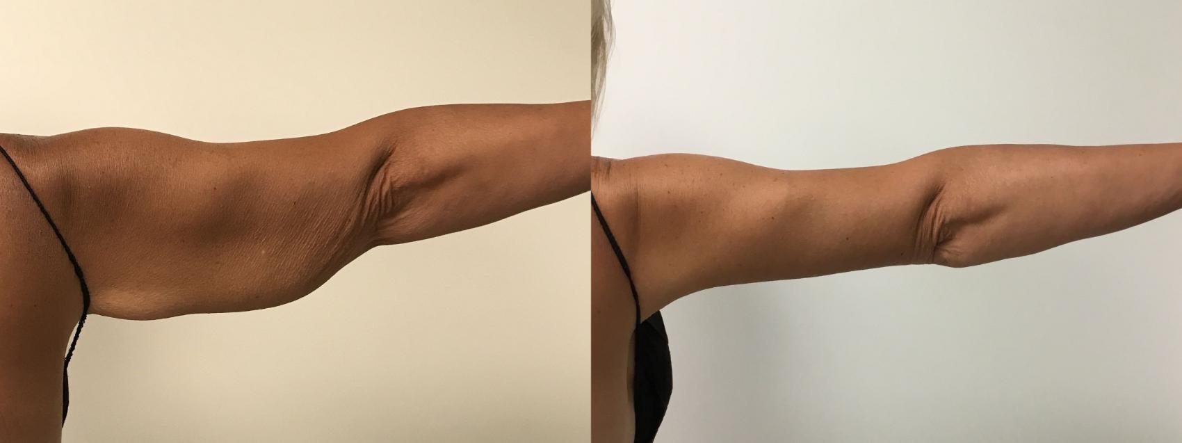 Before & After Arm Lift (Brachioplasty) Case 328 Front View in Barrington, Illinois
