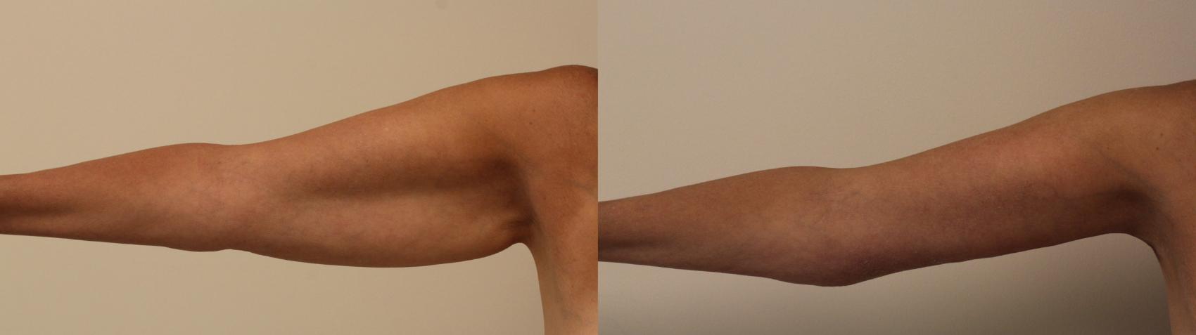 Before & After Arm Lift (Brachioplasty) Case 44 View #1 View in Barrington, Illinois