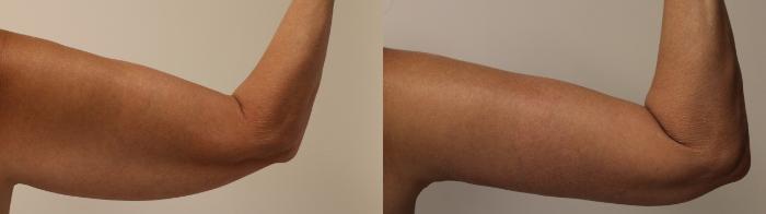 Before & After Arm Lift (Brachioplasty) Case 44 View #2 View in Barrington, Illinois