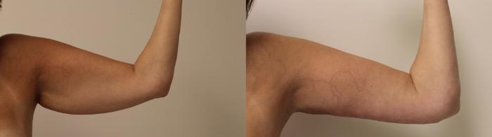Before & After Arm Lift (Brachioplasty) Case 44 View #3 View in Barrington, Illinois