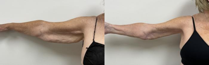 Before & After Arm Lift (Brachioplasty) Case 446 Front View in Barrington, Illinois