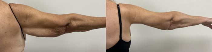 Before & After Arm Lift (Brachioplasty) Case 446 Right Side View in Barrington, Illinois