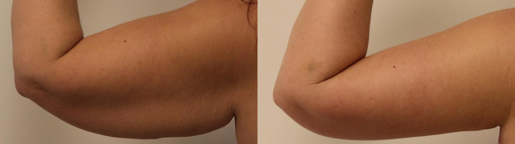 Before & After Arm Lift (Brachioplasty) Case 46 View #1 View in Barrington, Illinois