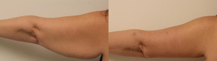 Before & After Arm Lift (Brachioplasty) Case 46 View #2 View in Barrington, Illinois