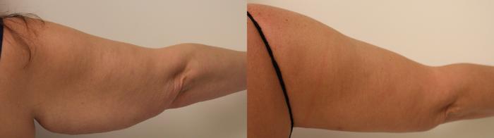Before & After Arm Lift (Brachioplasty) Case 46 View #3 View in Barrington, Illinois