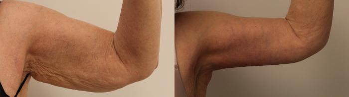 Before & After Arm Lift (Brachioplasty) Case 47 View #1 View in Barrington, Illinois