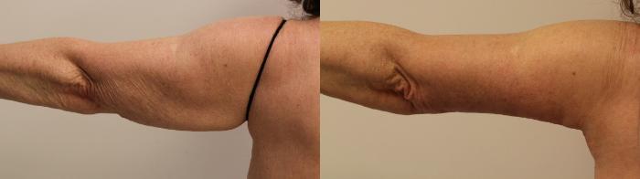 Before & After Arm Lift (Brachioplasty) Case 47 View #2 View in Barrington, Illinois