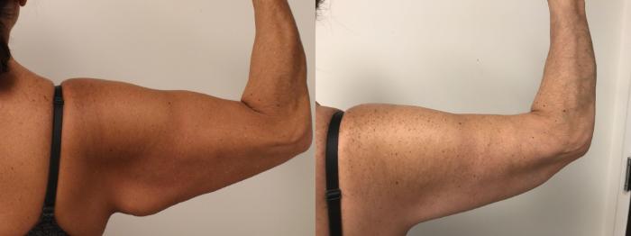 Before & After Arm Lift (Brachioplasty) Case 70 Back View in Barrington, Illinois
