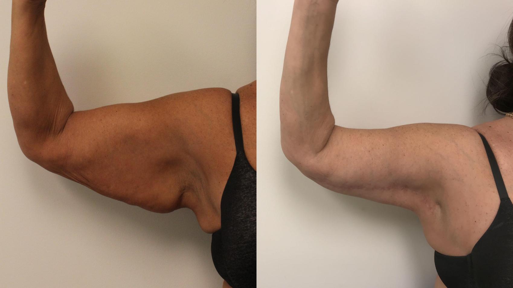 Before & After Arm Lift (Brachioplasty) Case 70 Front View in Barrington, Illinois
