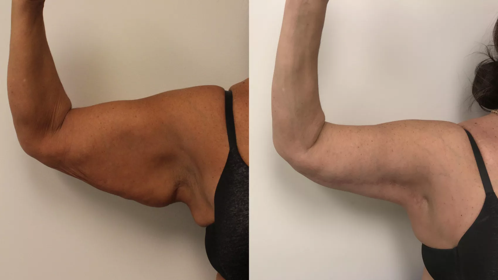 A before and after comparison of a young Caucasian woman who had a  brachioplasty. Corrective arm lift surgery which removes the sagging fat  layer from the triceps area. Photos