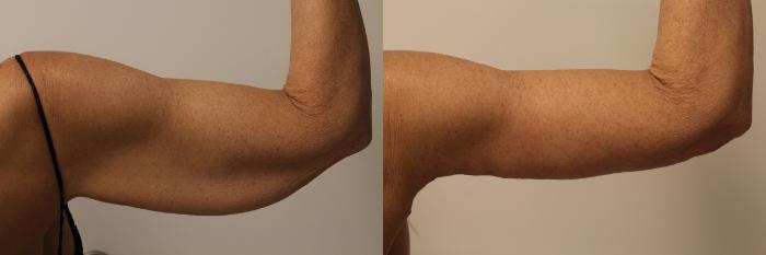 Before & After Arm Lift (Brachioplasty) Case 78 Back View in Barrington, Illinois