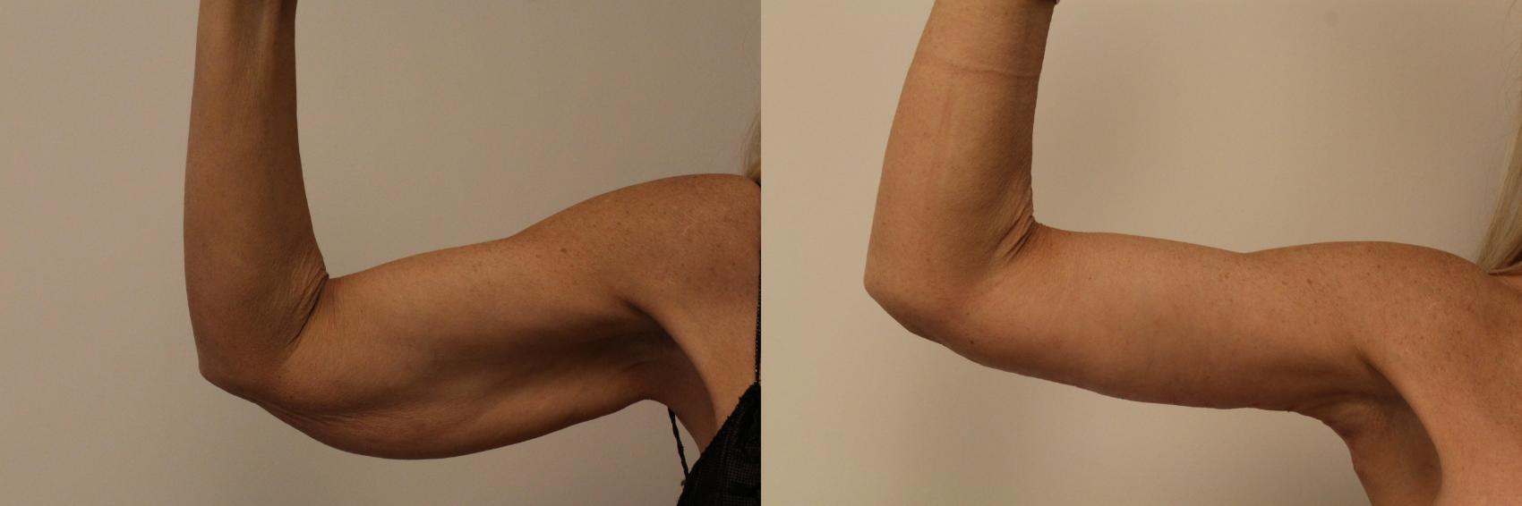 Before & After Arm Lift (Brachioplasty) Case 78 Front View in Barrington, Illinois