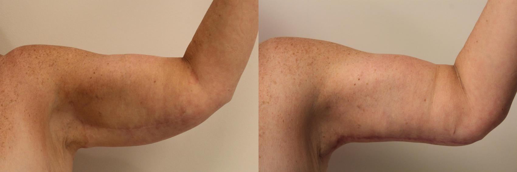 Before & After Arm Lift (Brachioplasty) Case 86 Front View in Barrington, Illinois