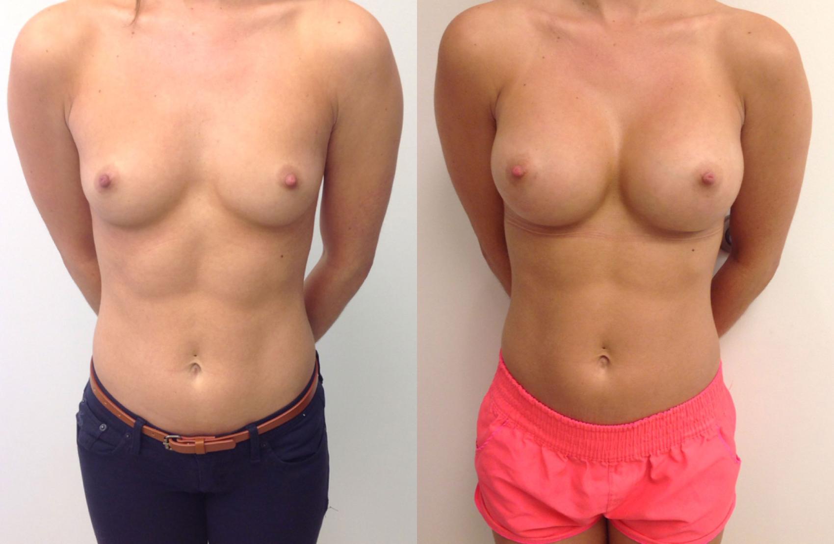 Before & After Breast Augmentation Case 10 View #1 View in Barrington, Illinois