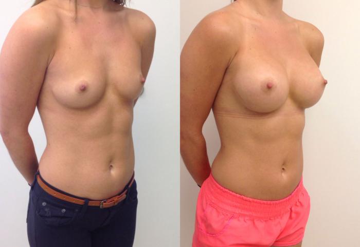 Before & After Breast Augmentation Case 10 View #2 View in Barrington, Illinois