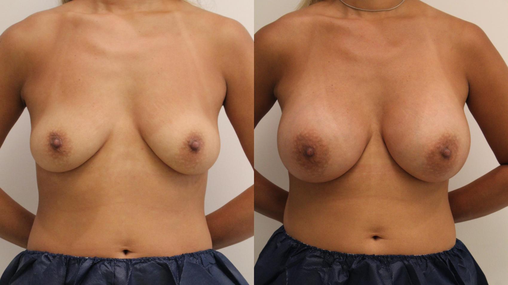 Before & After Breast Augmentation Case 105 Front View in Barrington, Illinois