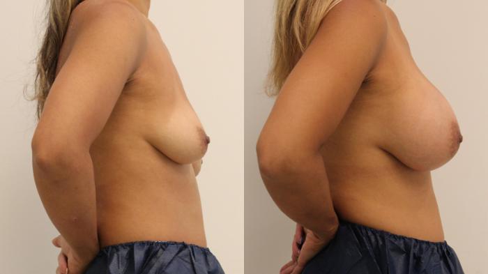 Before & After Breast Augmentation Case 105 Right Side View in Barrington, Illinois
