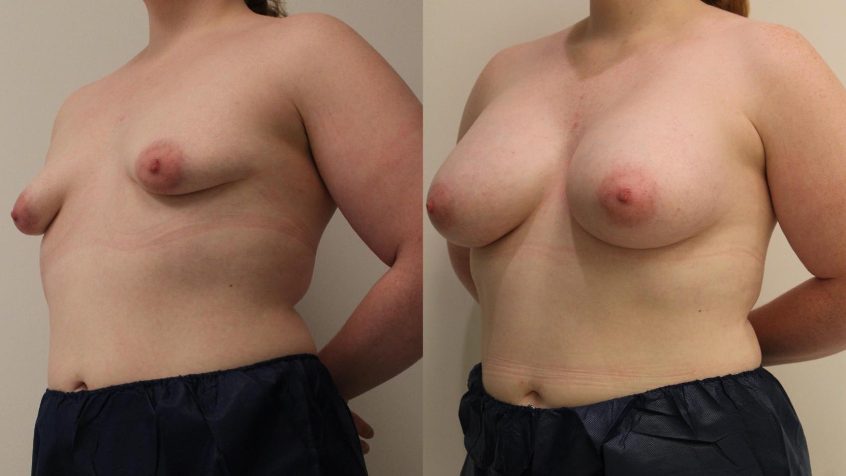 Before & After Breast Augmentation Case 108 Left Oblique View in Barrington, Illinois