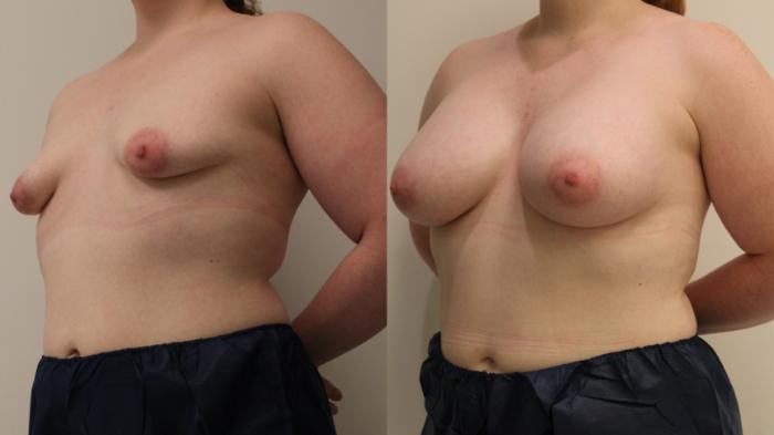 Before & After Breast Augmentation Case 108 Left Oblique View in Barrington, Illinois