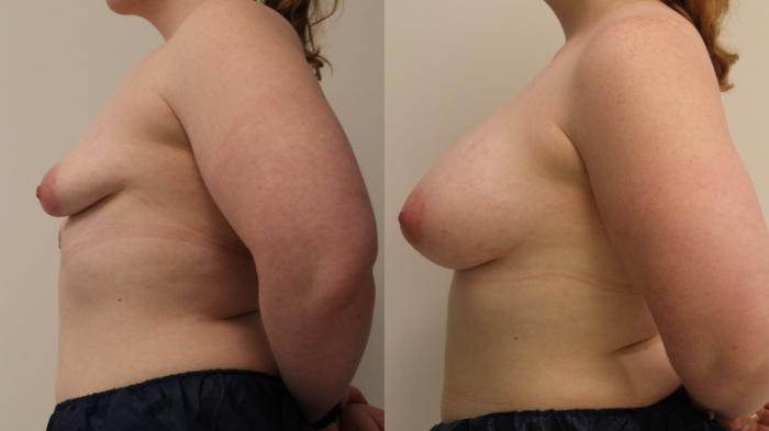 Before & After Breast Augmentation Case 108 Left Side View in Barrington, Illinois