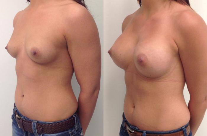 Before & After Breast Augmentation Case 11 View #2 View in Barrington, Illinois