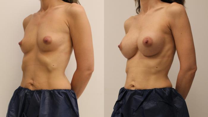 Before & After Breast Augmentation Case 110 Left Oblique View in Barrington, Illinois
