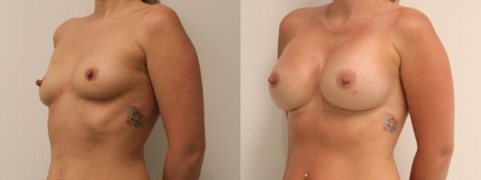 Before & After Breast Augmentation Case 114 Left Oblique View in Barrington, Illinois