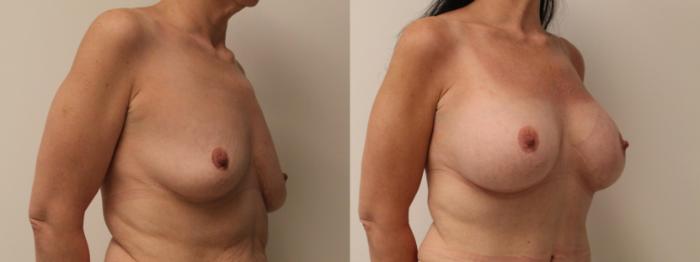 Before & After Breast Augmentation Case 116 Right Oblique View in Barrington, Illinois