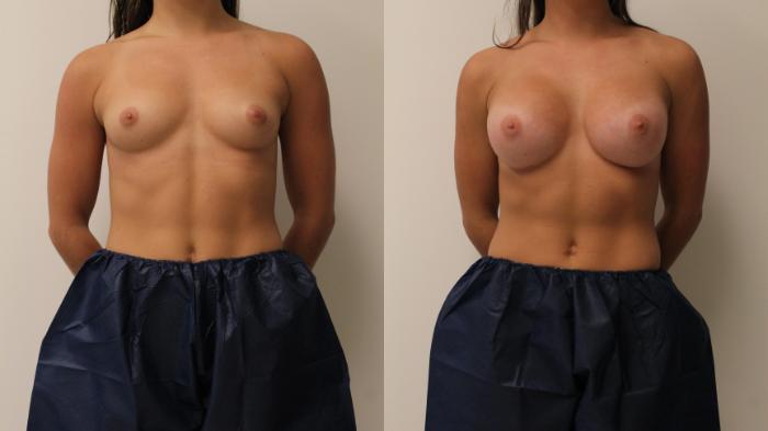 Before & After Breast Augmentation Case 126 Front View in Barrington, Illinois