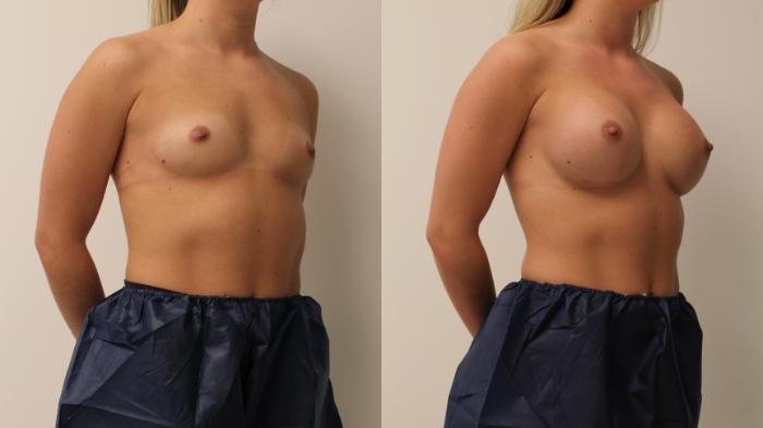 Before & After Breast Augmentation Case 127 Right Oblique View in Barrington, Illinois